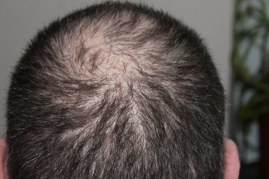 Experiencing Hair Loss? Uric Acid Might Be the Problem